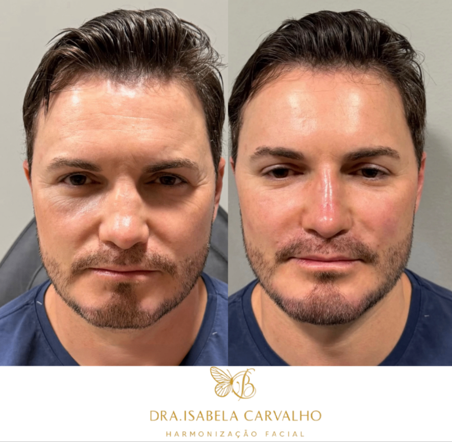 Resultado antes e depois 1 — Dra. Isabela Carvalho