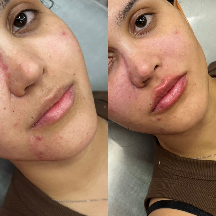 Resultado antes e depois 2 — Dra. Isabela Carvalho