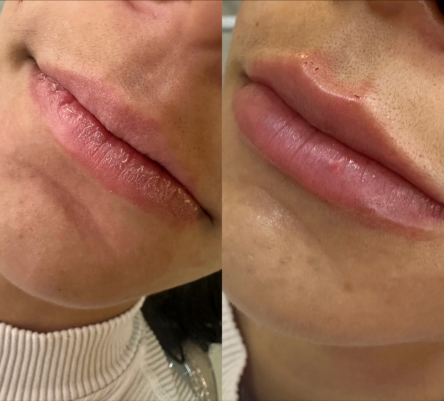 Resultado antes e depois 3 — Dra. Isabela Carvalho