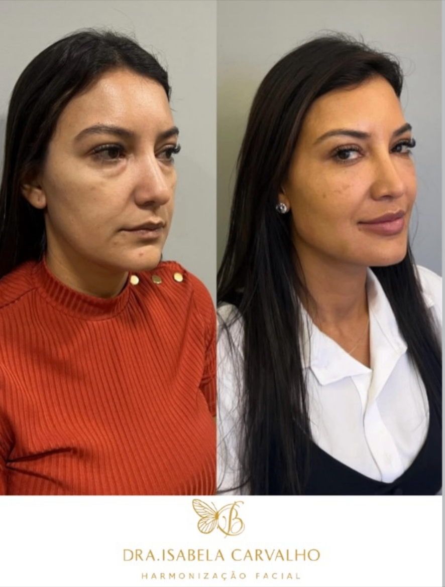 Resultado antes e depois 4 — Dra. Isabela Carvalho