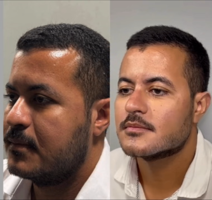 Resultado antes e depois 5 — Dra. Isabela Carvalho