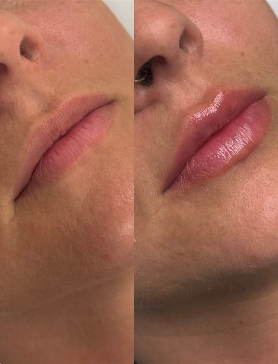 Resultado antes e depois 6 — Dra. Isabela Carvalho