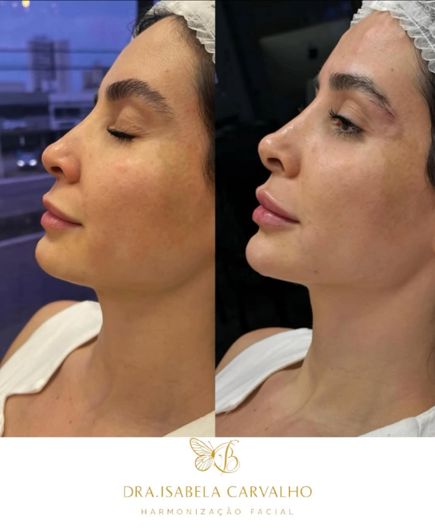 Resultado antes e depois 7 — Dra. Isabela Carvalho