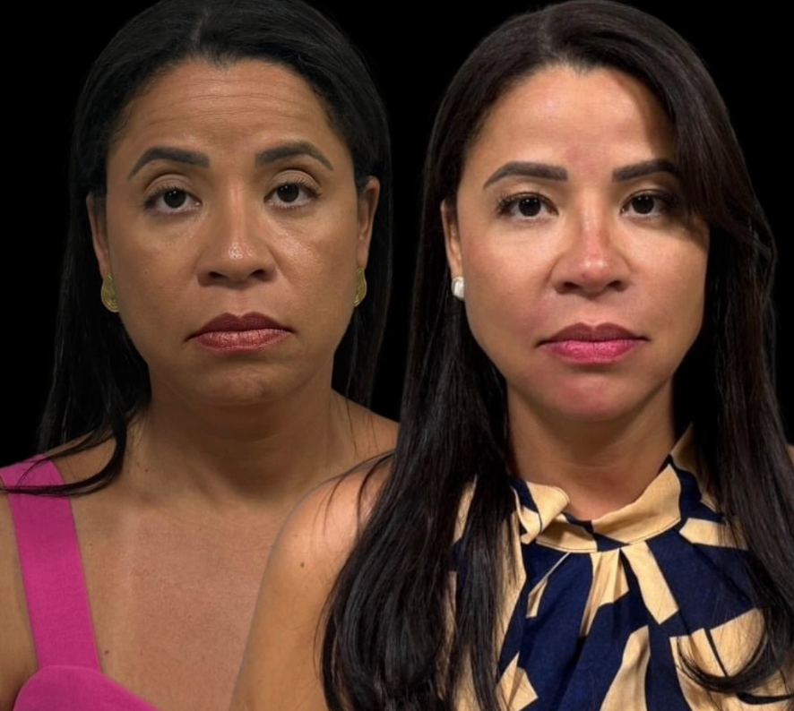 Resultado antes e depois 8 — Dra. Isabela Carvalho